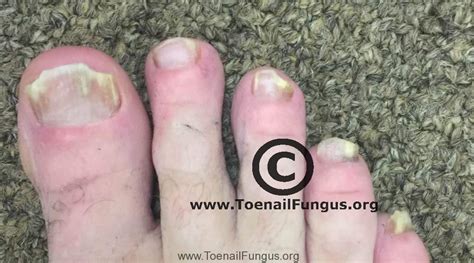 Before and after pics using Terbinafine – Toenail Fungus