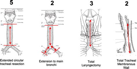 Successful Tracheal Replacement In Humans Using Autologous Tissues An