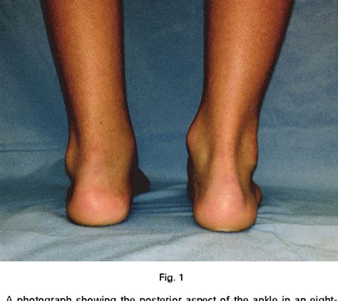 Figure 1 From The Quality Of Achilles Tendon Repair Five To Eight Years