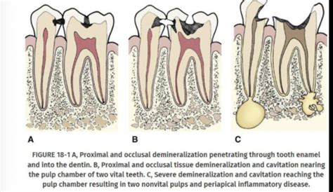 Lecture 81 Interpretation Of Dental Caries Flashcards Quizlet