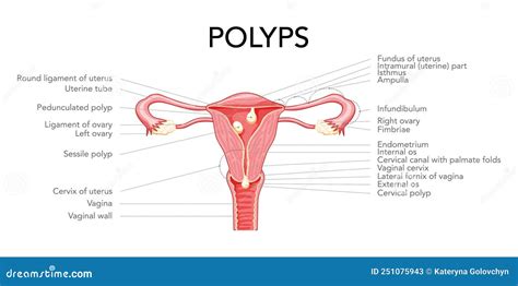 Polyp In The Uterus With Inscriptions Diagram Female Reproductive