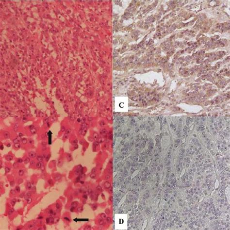 Histopathology of adrenocortical carcinoma. ( a ) Pleomorphic tumour ...