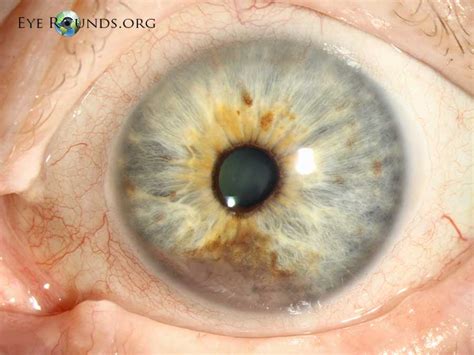 Iris Melanoma :: The University of Iowa, Ophthalmology