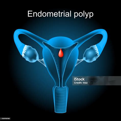 Endometrial Polyp Cross Section Of A Human Uterus With Uterine Polyp