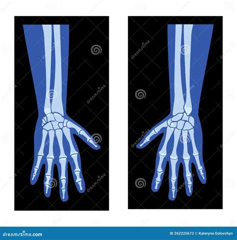 Ulna X-ray Front Or Anterior View. Osteology Of The Human Skeleton, Arm Or Upper Limb Bones 3D