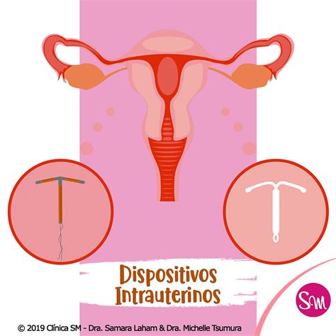 Guia Completo Sobre Dispositivos Intrauterinos DIUs