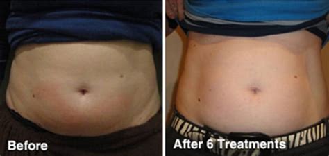 Fat Cavitation Results - The Global Beauty Group