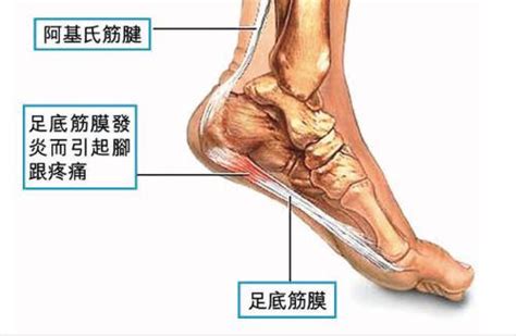 跑步的你，如果常感到脚后跟疼，脚底靠近脚后跟的地方，按压也疼，十有八九是足底筋膜炎，让我们一起灭了它 知乎