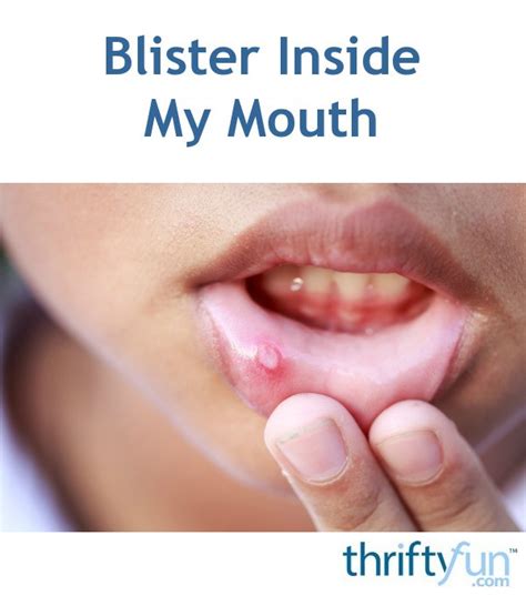 Treating a Blister Inside My Mouth | ThriftyFun