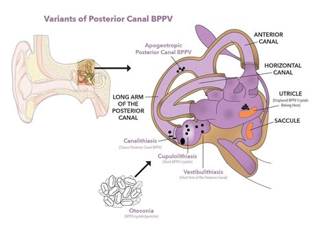 Posterior Canal BPPV Variants Dr Kim Bell DPT