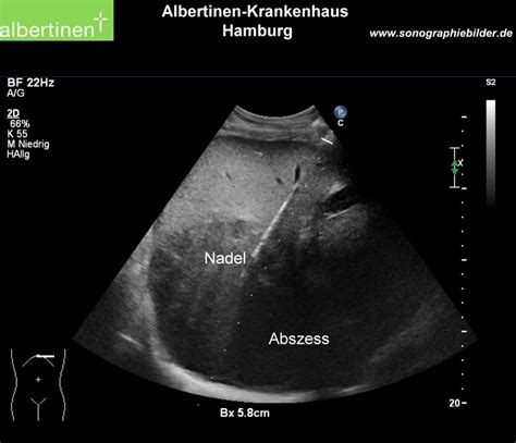 Abszess Punktionsnadel Leber Sono Text Doccheck