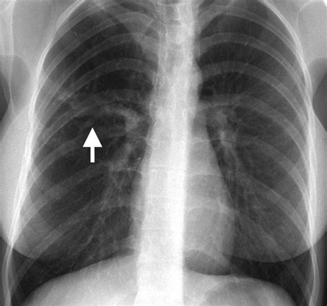 Mdct Demonstration Of Intralobar Pulmonary Sequestration Of The Right