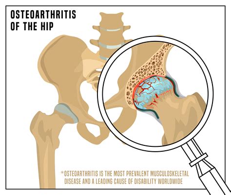 Collection Pictures Pictures Of Arthritic Hip Joints Stunning