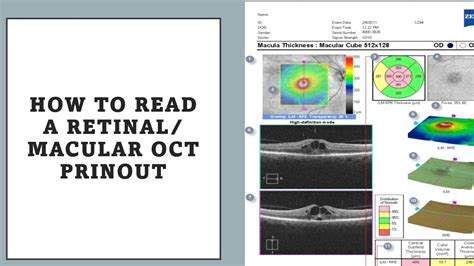 Normal Oct Macula