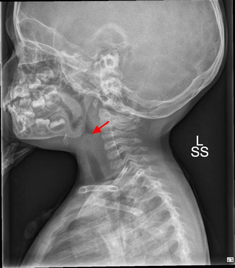 Epiglottitis Causes Symptoms Diagnosis Treatment