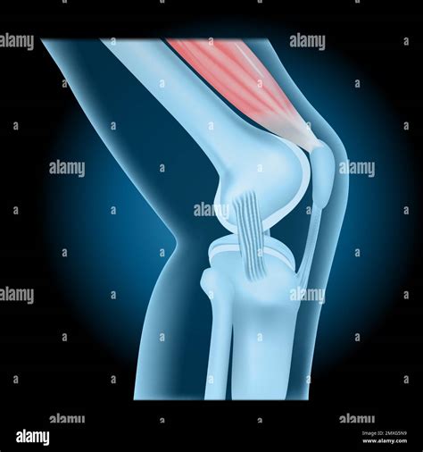 Knee Joint With Quadriceps Side View Of Human Knee With Glowing Effect