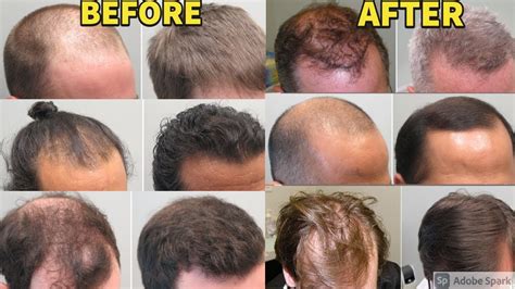 Beforeafter Results Of Finasteride And Minoxidil Users For Treating Hair Loss Youtube