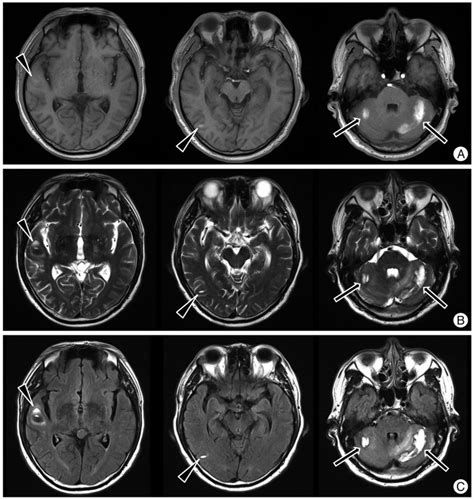 A Craniotomy Surgery Procedure For Chronic Brain Imaging The Meta