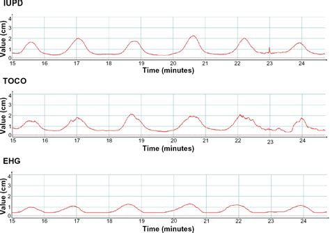 Comparing Uterine Electromyography Tocodynamometer To, 49% OFF