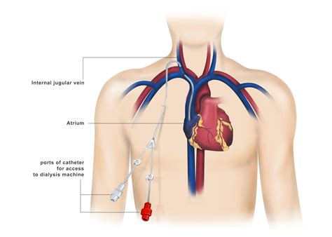 Dialysis Access Surgery Dr Ahmed Farah Abdulrahman