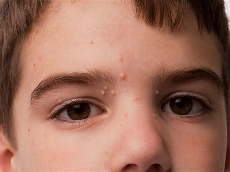 Molluscum Contagiosum Symptoms Causes And Treatments 58 Off