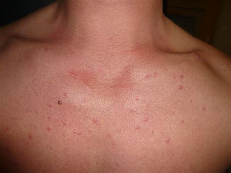 Fungal Acne On Body