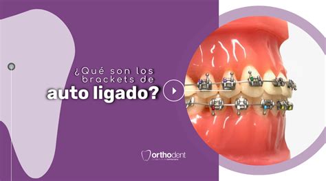 Qué son los brackets de autoligado y cómo difieren de los brackets