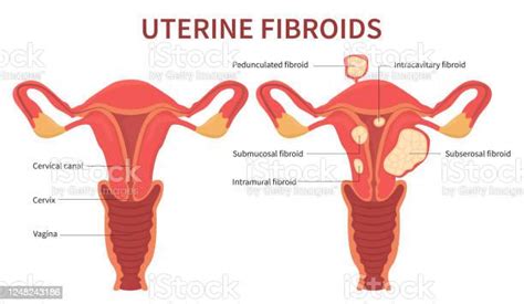 Woman Uterine Fibroids Diagram On White Background Stock Illustration