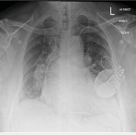 Chest Radiography Showing Pulmonary Edema And Cardiac Resynchronization