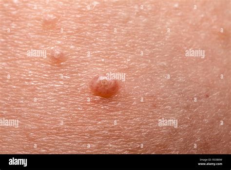 Molluscum Contagiosum Fotografías E Imágenes De Alta Resolución Alamy