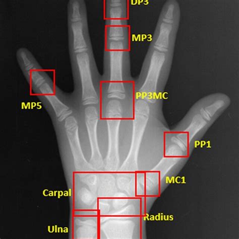 Automated Detection Of Regions Of Interest In Addition To The ROIs