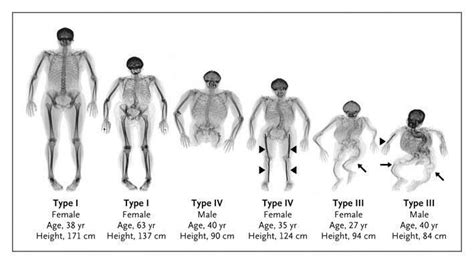 New test for Osteogenesis Imperfecta or brittle bone disease - Ortho Spine News