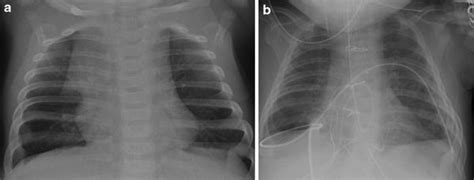 Of The Pediatric Thymus And Thymic Disorders Radiology Key