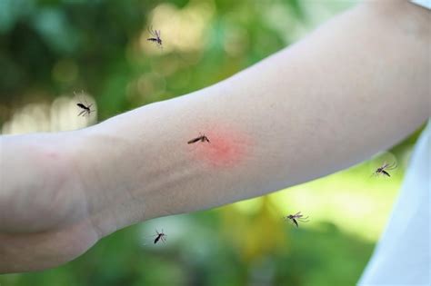 Picadura De Mosquito En El Brazo Adulto Con Erupci N Cut Nea Y Alergia