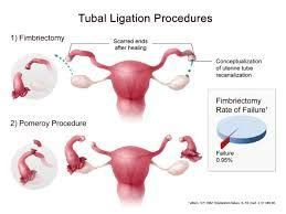 Tubal Ligation Reversal Restores A Womans Fertility After A Tubal