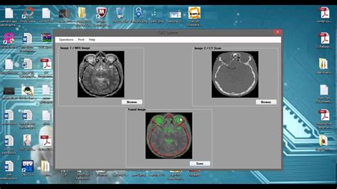 Cad Computer Aided Diagnosis System Youtube