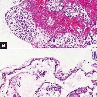 Magnetic Resonance Imaging Mri Images Of A Cystic Sellar Lesion Found