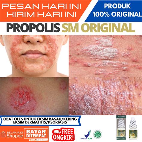 Jual Obat Eksim Basah Kering Eksim Dermatitis Psoriasis Obat