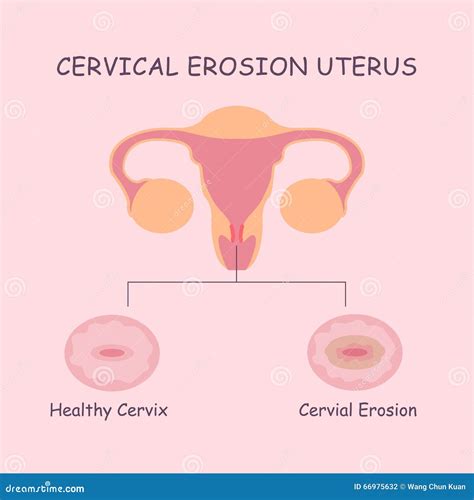 Uterus And Cervical Erosion Stock Vector Illustration Of Human