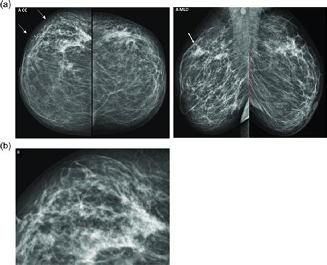 A And B Screening Mammogram Of A 43 Year Old Premenopausal Female