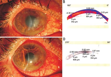 Descemet Membrane Detachment After Intrastromal Injection A This