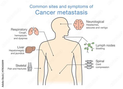 Most Common Sites And Symptoms Of Cancer Metastasis Illustration About