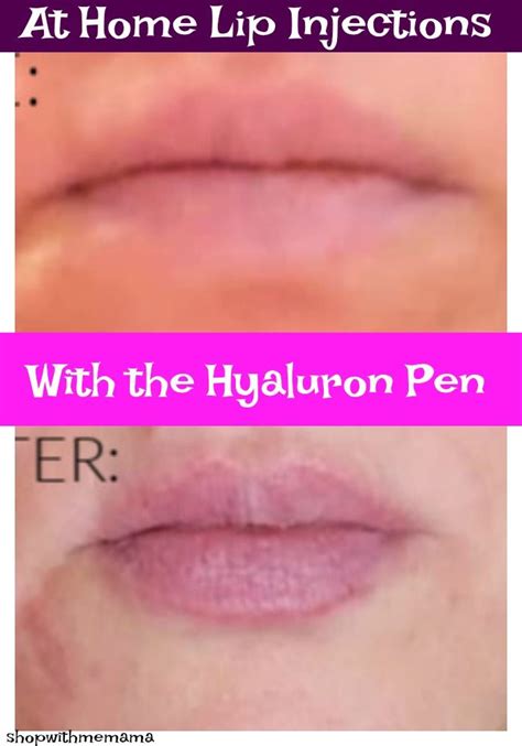 Diy Lip Filler Pen Leonida Milner