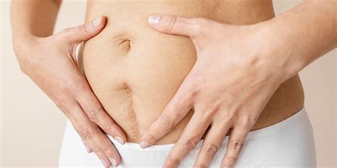 How To Get Rid Of Stretch Marks