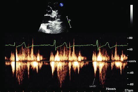 Left Atrial Appendage Laa Pulsed Wave Doppler Velocities Obtained In