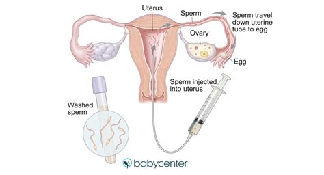 Iui Intra Uterine Insemination