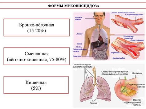 Муковисцидоз - презентация онлайн