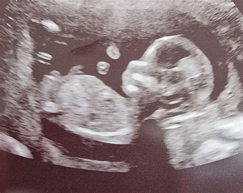 Just For Fun 12 Week Scan Gender Guesses Mumsnet