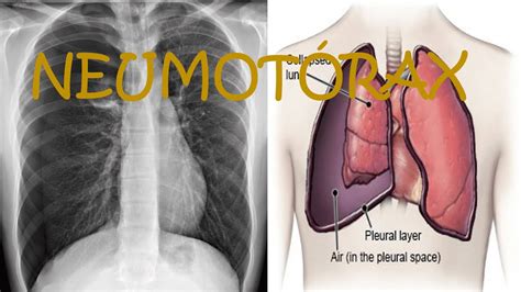 CÓMO SE VE UN NEUMOTÓRAX EN UNA RADIOGRAFÍA Y POR QUÉ SE PRODUCE YouTube