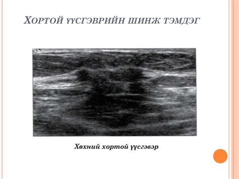 хөхний хэт авиан оношлогоо